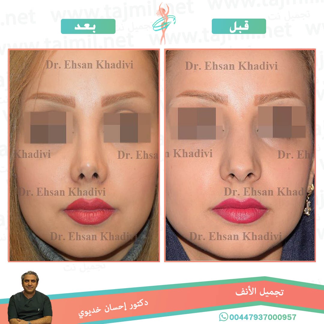  - دکتور إحسان خدیوي عملية تجميل الانف في ايران مع تجميل نت