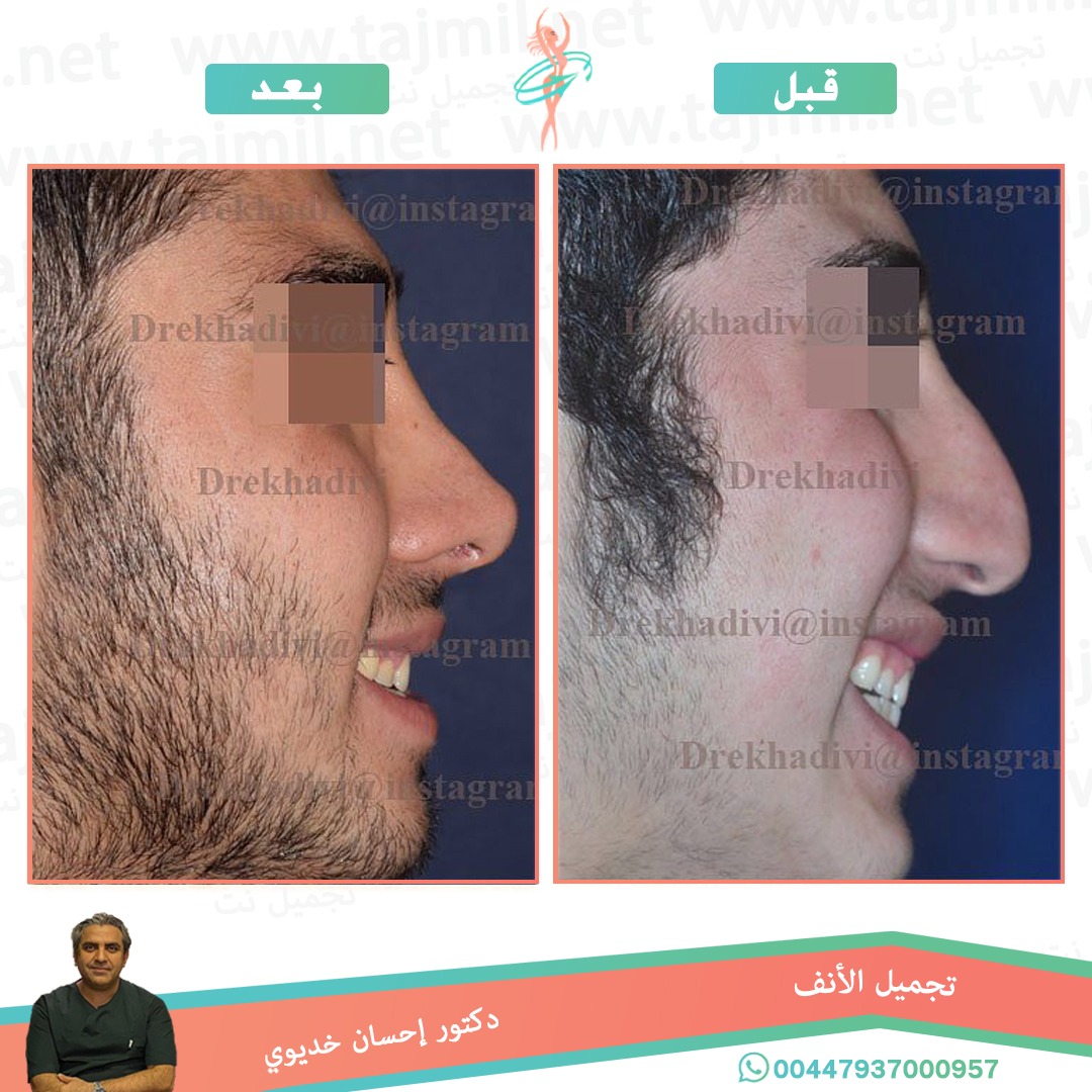  - دکتور إحسان خدیوي عملية تجميل الانف في ايران مع تجميل نت