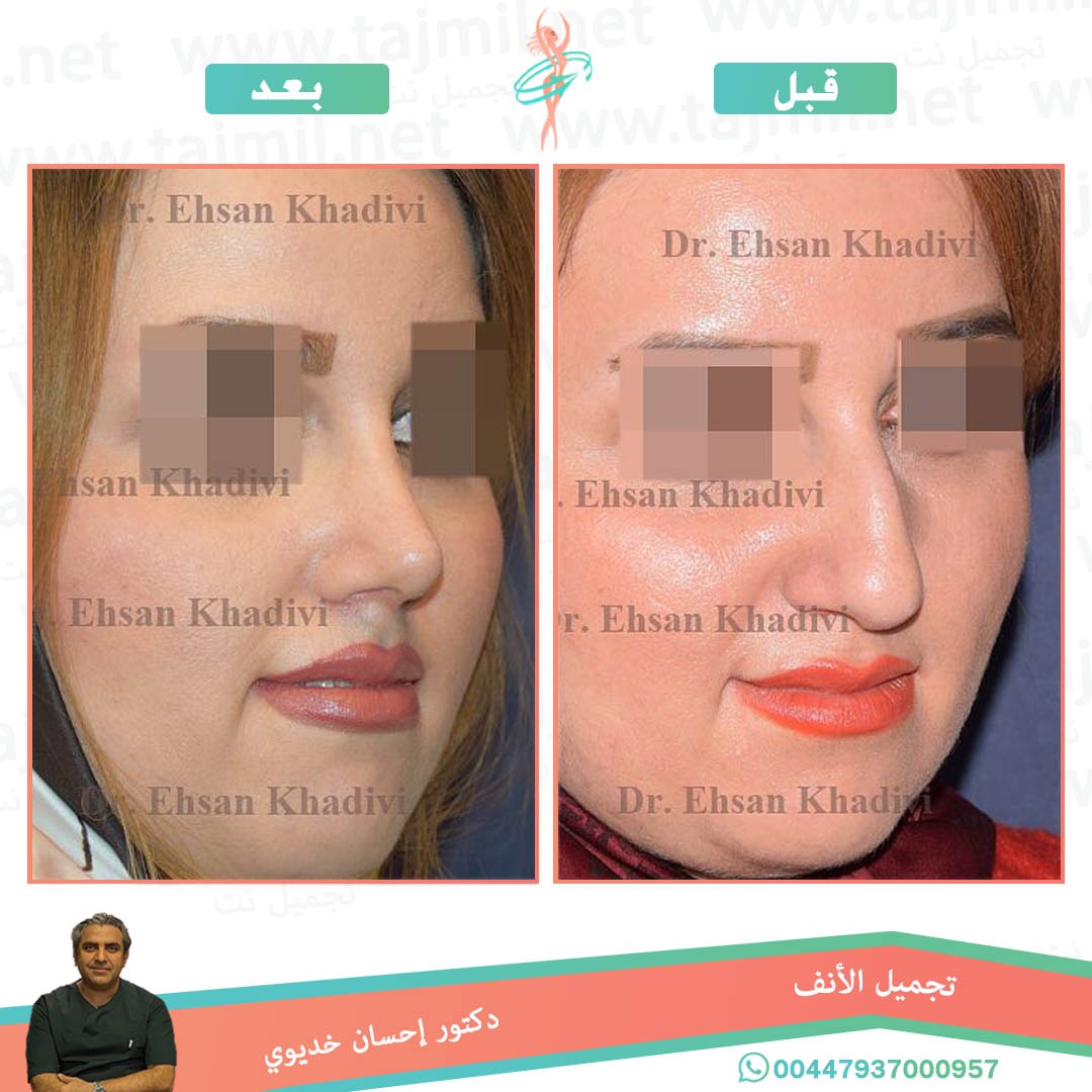  - دکتور إحسان خدیوي عملية تجميل الانف في ايران مع تجميل نت