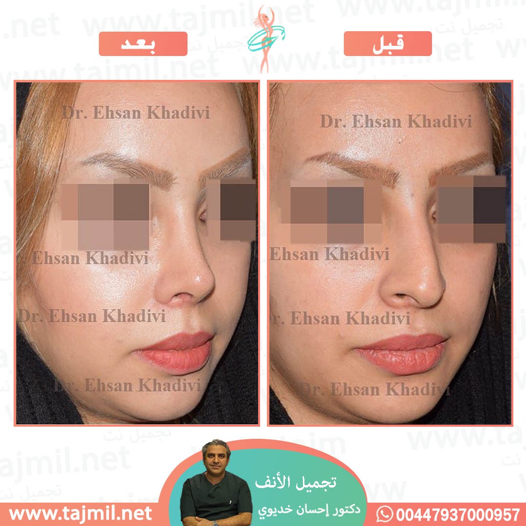  - دکتور إحسان خدیوي عملية تجميل الانف في ايران مع تجميل نت