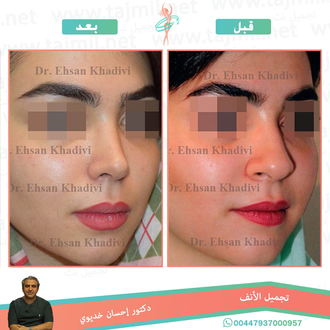  - دکتور إحسان خدیوي عملية تجميل الانف في ايران مع تجميل نت