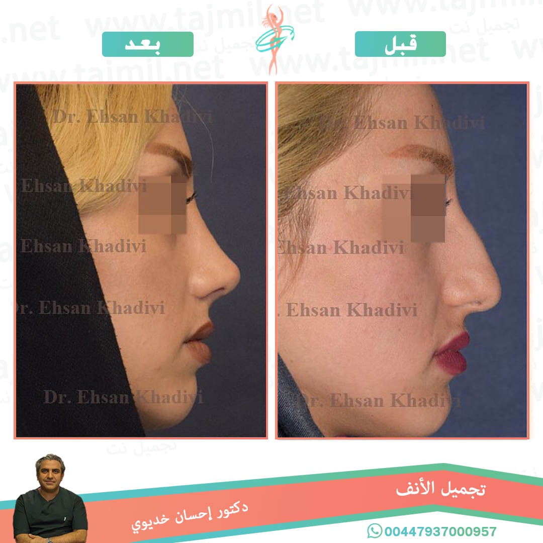  - دکتور إحسان خدیوي عملية تجميل الانف في ايران مع تجميل نت