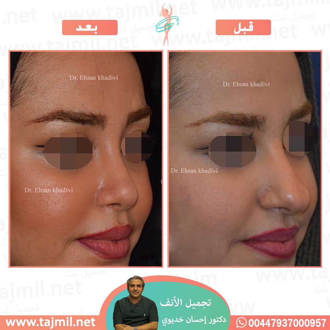  - دکتور إحسان خدیوي عملية تجميل الانف في ايران مع تجميل نت