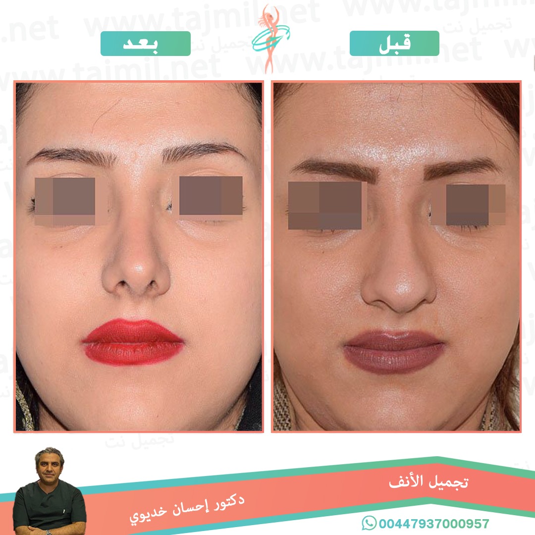  - دکتور إحسان خدیوي عملية تجميل الانف في ايران مع تجميل نت