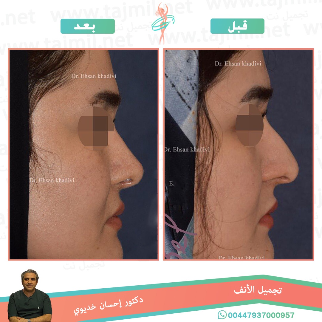  - دکتور إحسان خدیوي عملية تجميل الانف في ايران مع تجميل نت