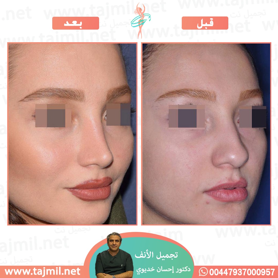  - دکتور إحسان خدیوي عملية تجميل الانف في ايران مع تجميل نت