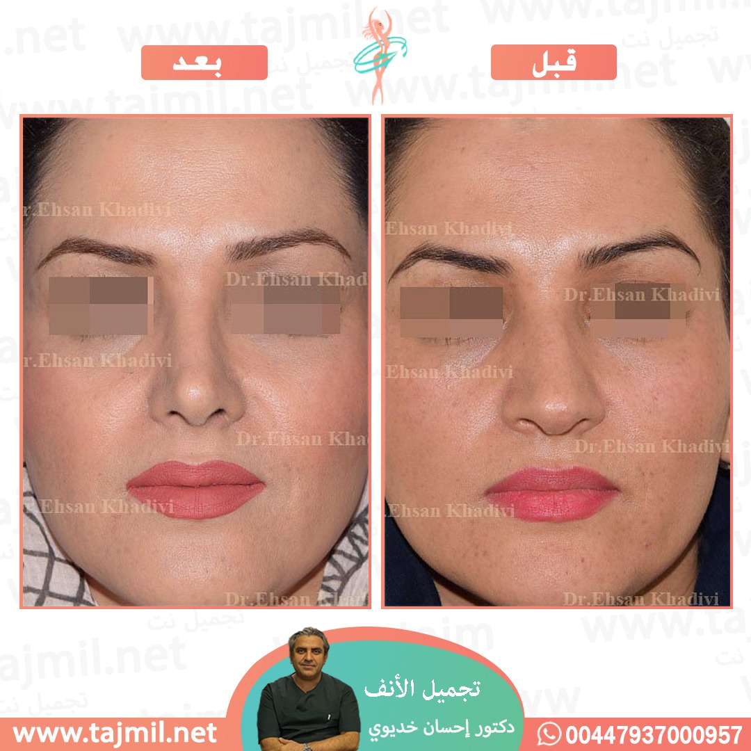  - دکتور إحسان خدیوي عملية تجميل الانف في ايران مع تجميل نت