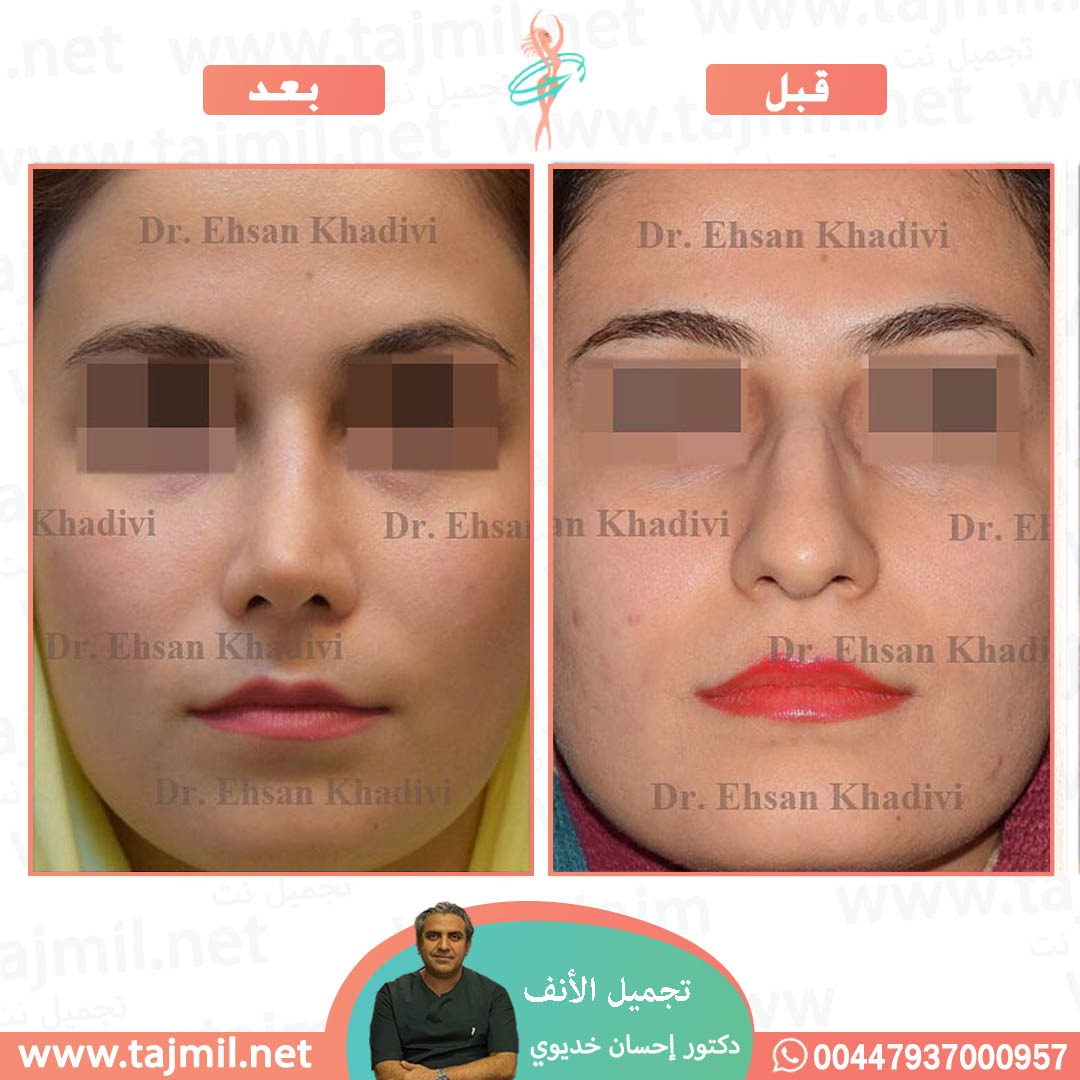  - دکتور إحسان خدیوي عملية تجميل الانف في ايران مع تجميل نت