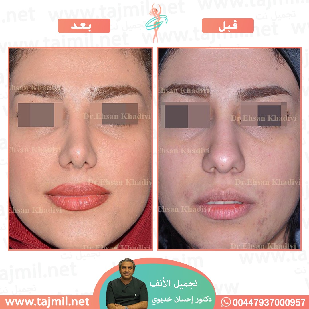  - دکتور إحسان خدیوي عملية تجميل الانف في ايران مع تجميل نت