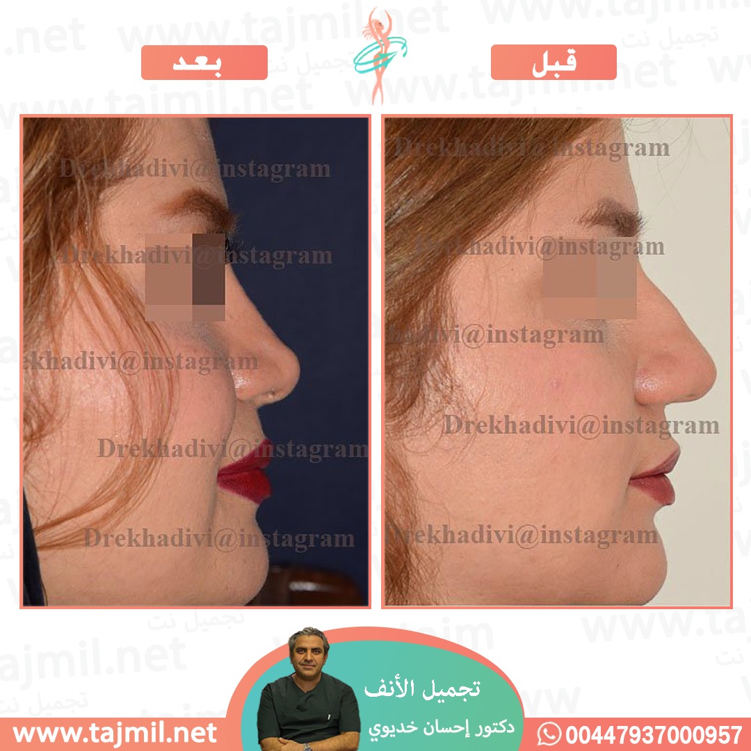  - دکتور إحسان خدیوي عملية تجميل الانف في ايران مع تجميل نت