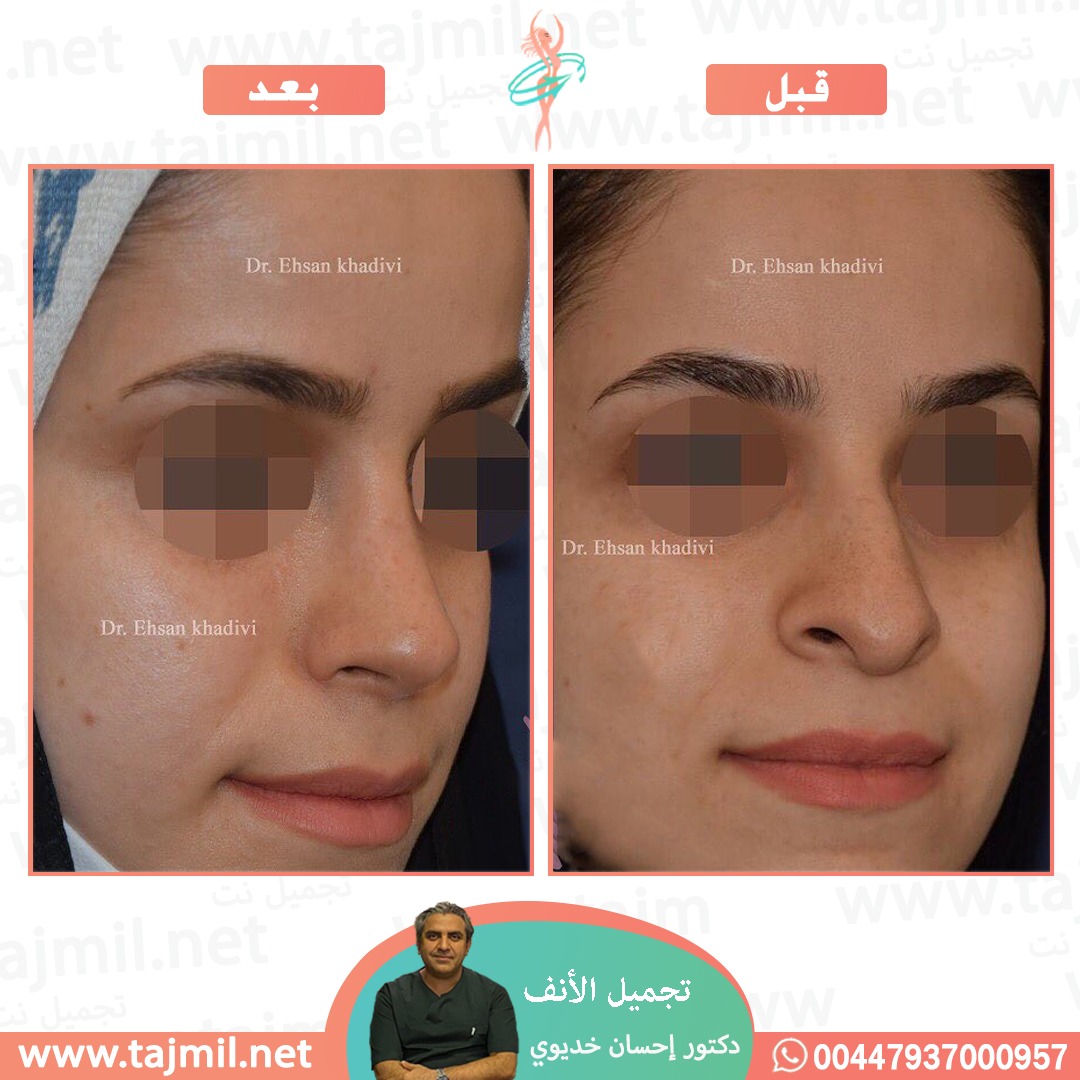  - دکتور إحسان خدیوي عملية تجميل الانف في ايران مع تجميل نت