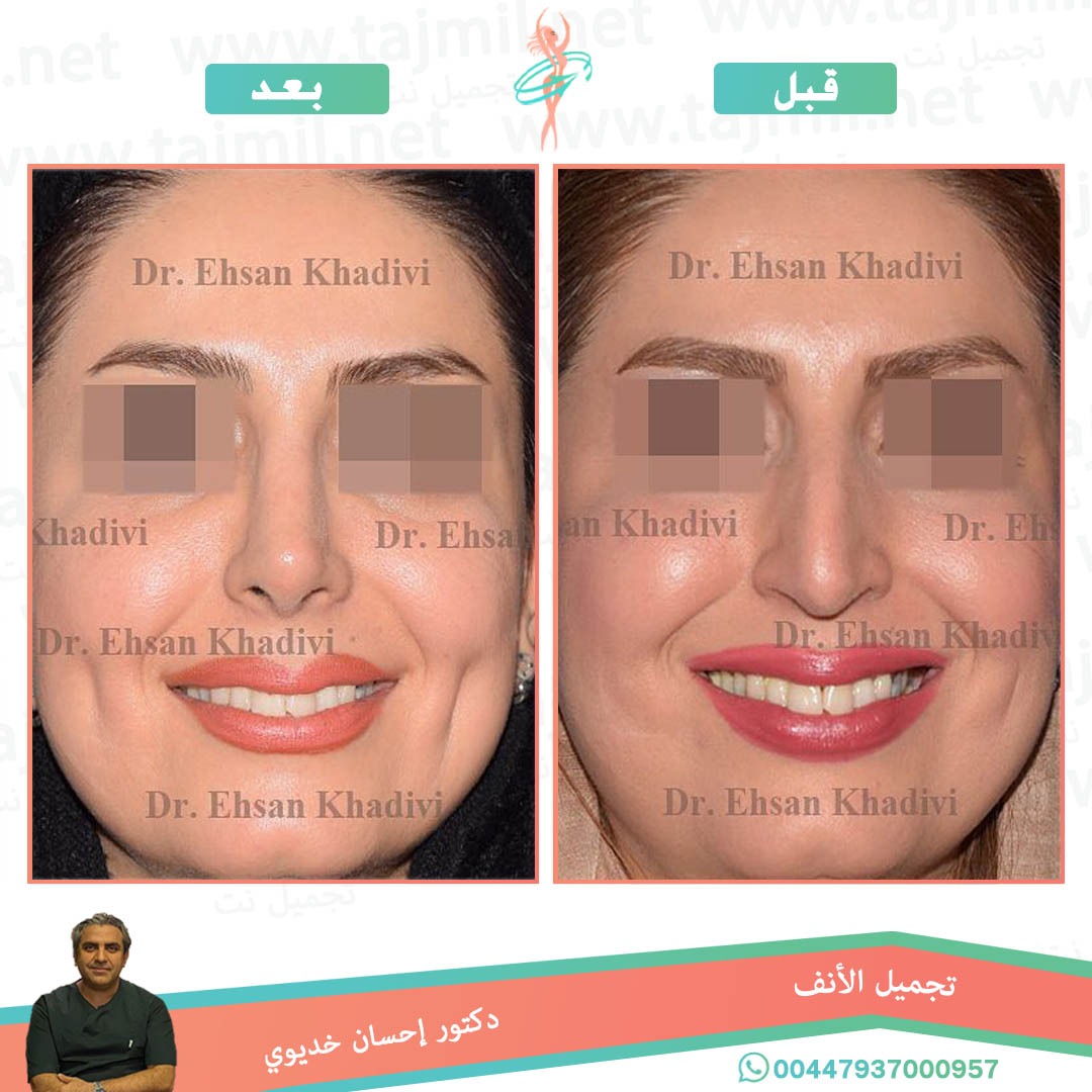  - دکتور إحسان خدیوي عملية تجميل الانف في ايران مع تجميل نت