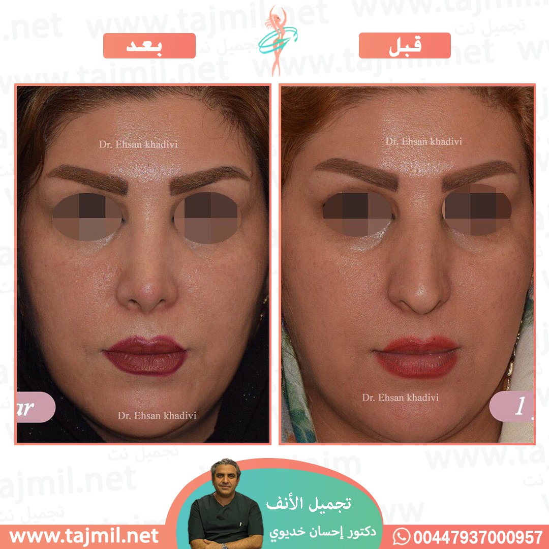  - دکتور إحسان خدیوي عملية تجميل الانف في ايران مع تجميل نت