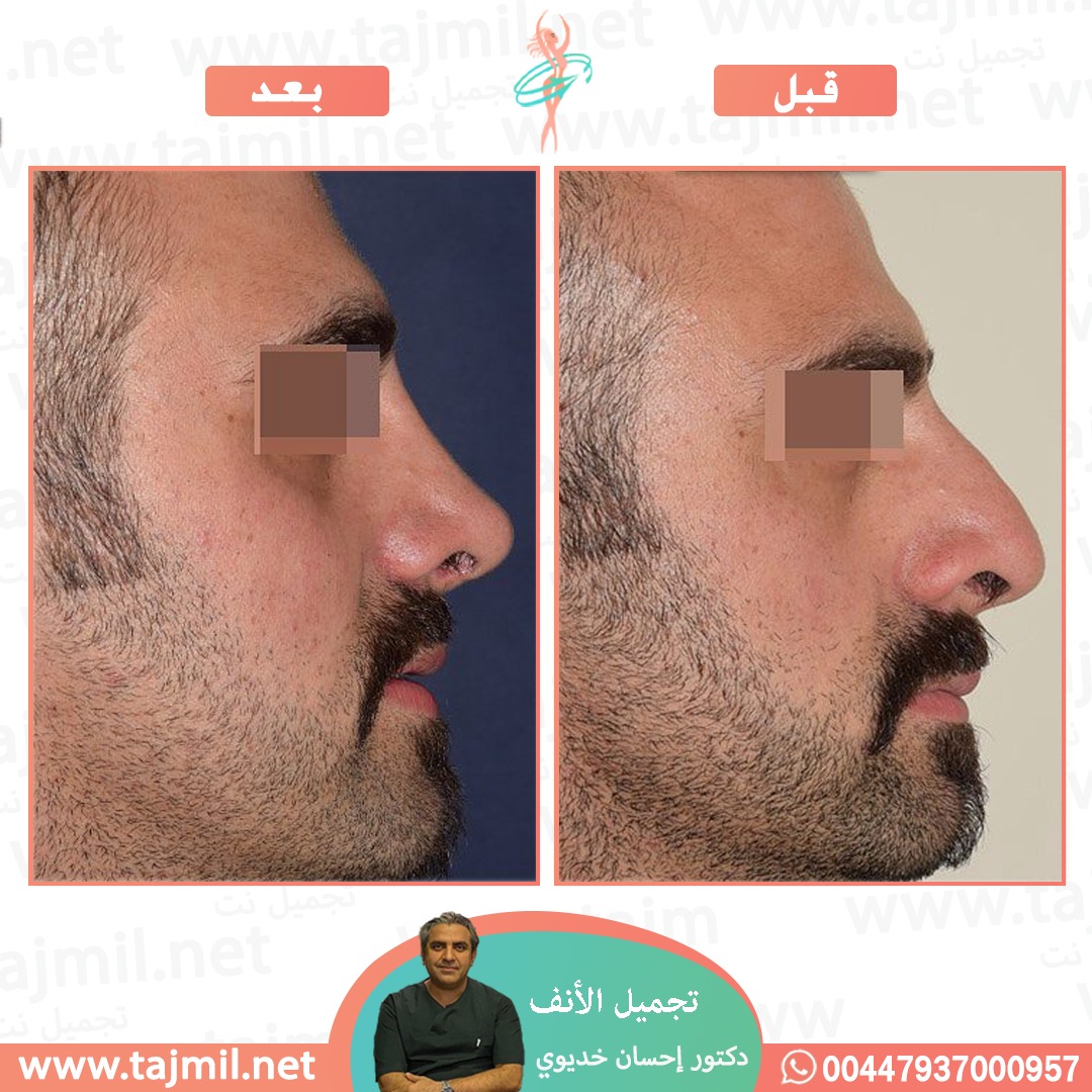  - دکتور إحسان خدیوي عملية تجميل الانف في ايران مع تجميل نت