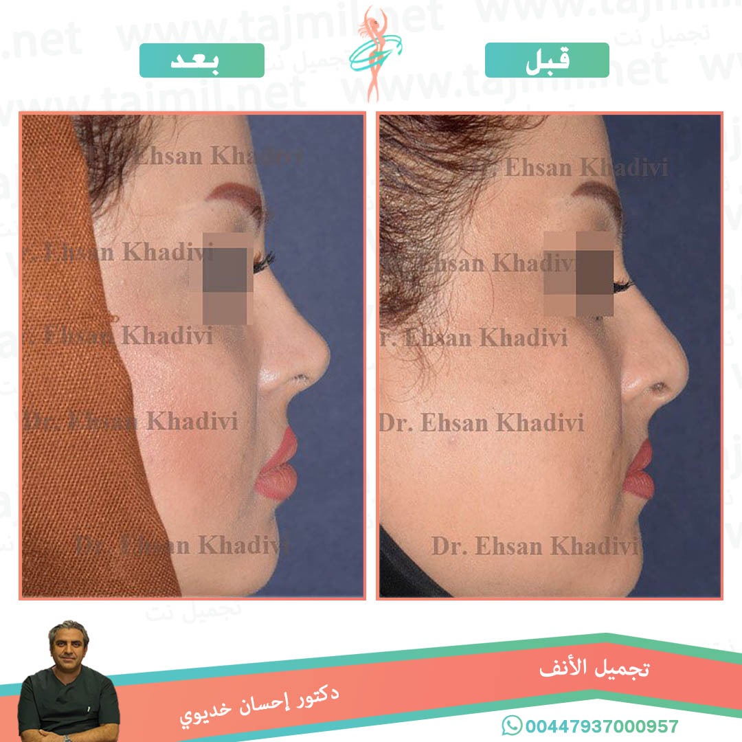  - دکتور إحسان خدیوي عملية تجميل الانف في ايران مع تجميل نت