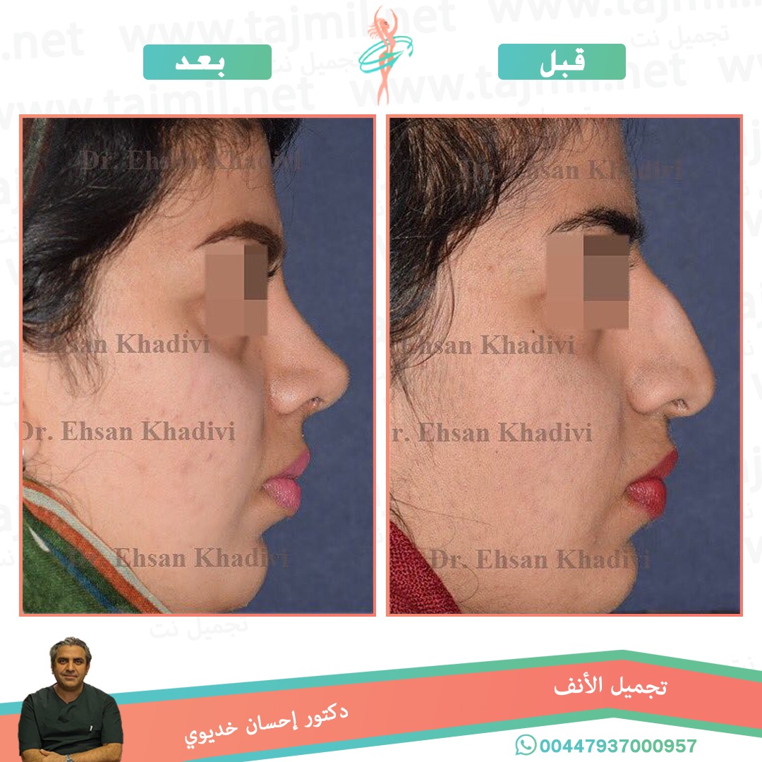  - دکتور إحسان خدیوي عملية تجميل الانف في ايران مع تجميل نت