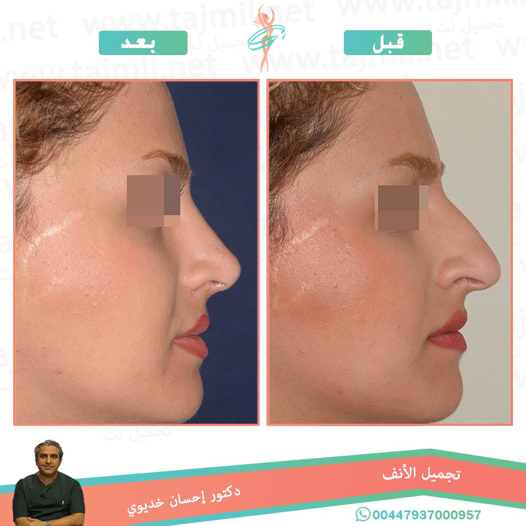  - دکتور إحسان خدیوي عملية تجميل الانف في ايران مع تجميل نت