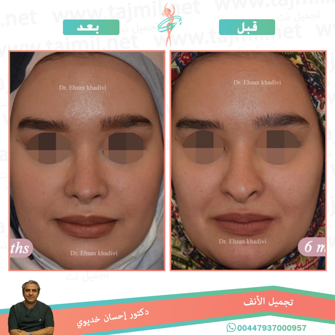  - دکتور إحسان خدیوي عملية تجميل الانف في ايران مع تجميل نت