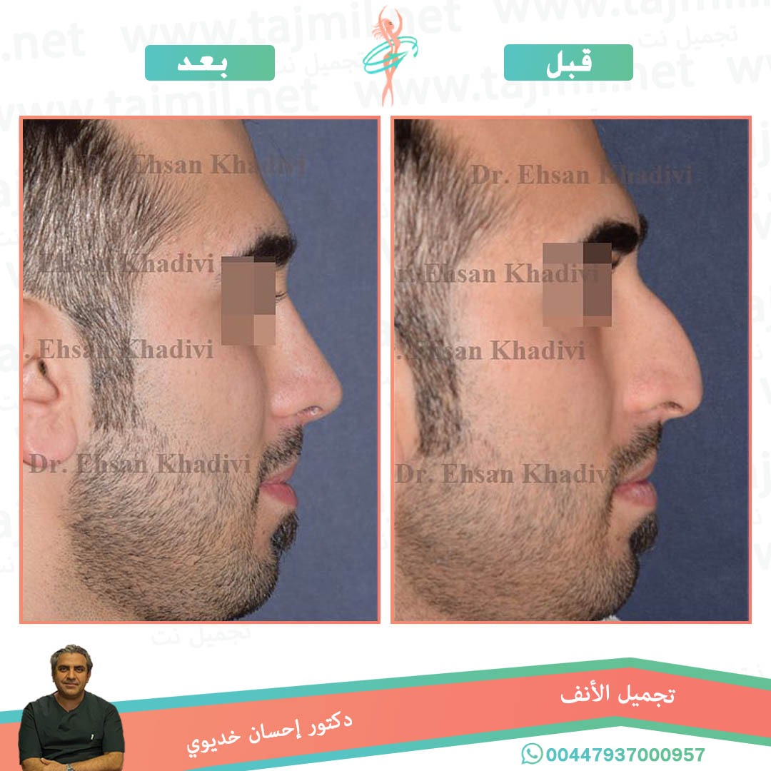  - دکتور إحسان خدیوي عملية تجميل الانف في ايران مع تجميل نت