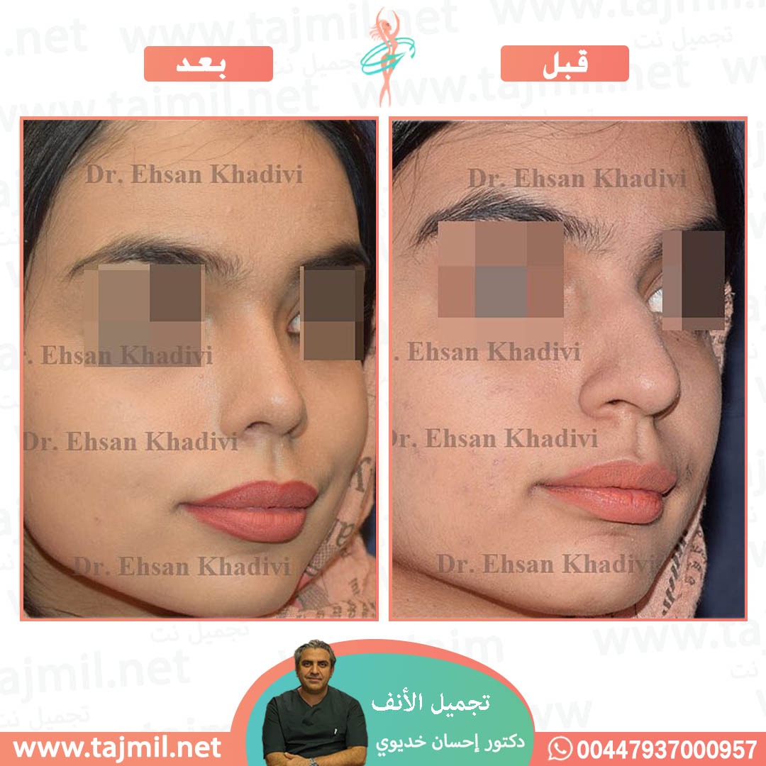  - دکتور إحسان خدیوي عملية تجميل الانف في ايران مع تجميل نت