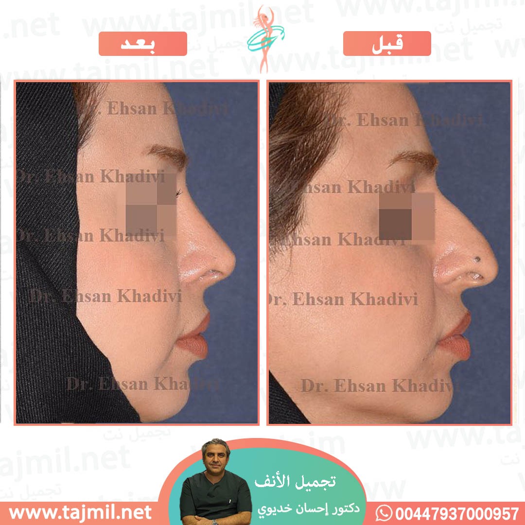  - دکتور إحسان خدیوي عملية تجميل الانف في ايران مع تجميل نت