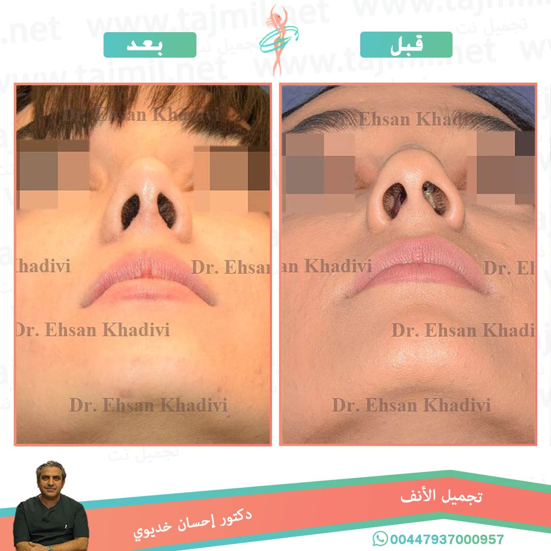  - دکتور إحسان خدیوي عملية تجميل الانف في ايران مع تجميل نت