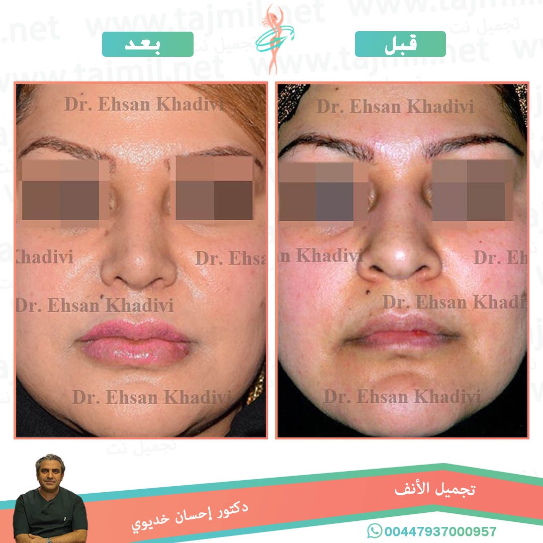  - دکتور إحسان خدیوي عملية تجميل الانف في ايران مع تجميل نت