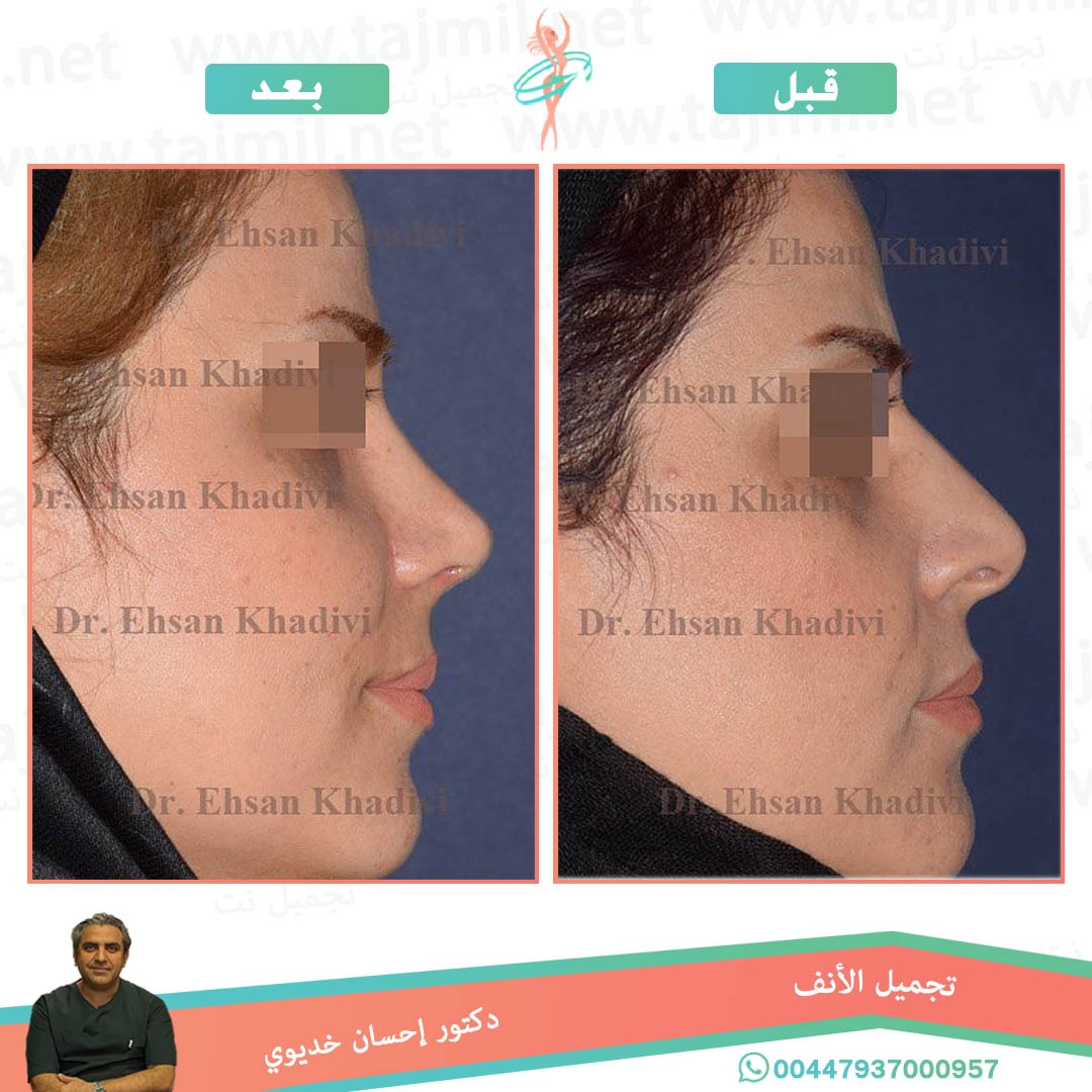  - دکتور إحسان خدیوي عملية تجميل الانف في ايران مع تجميل نت