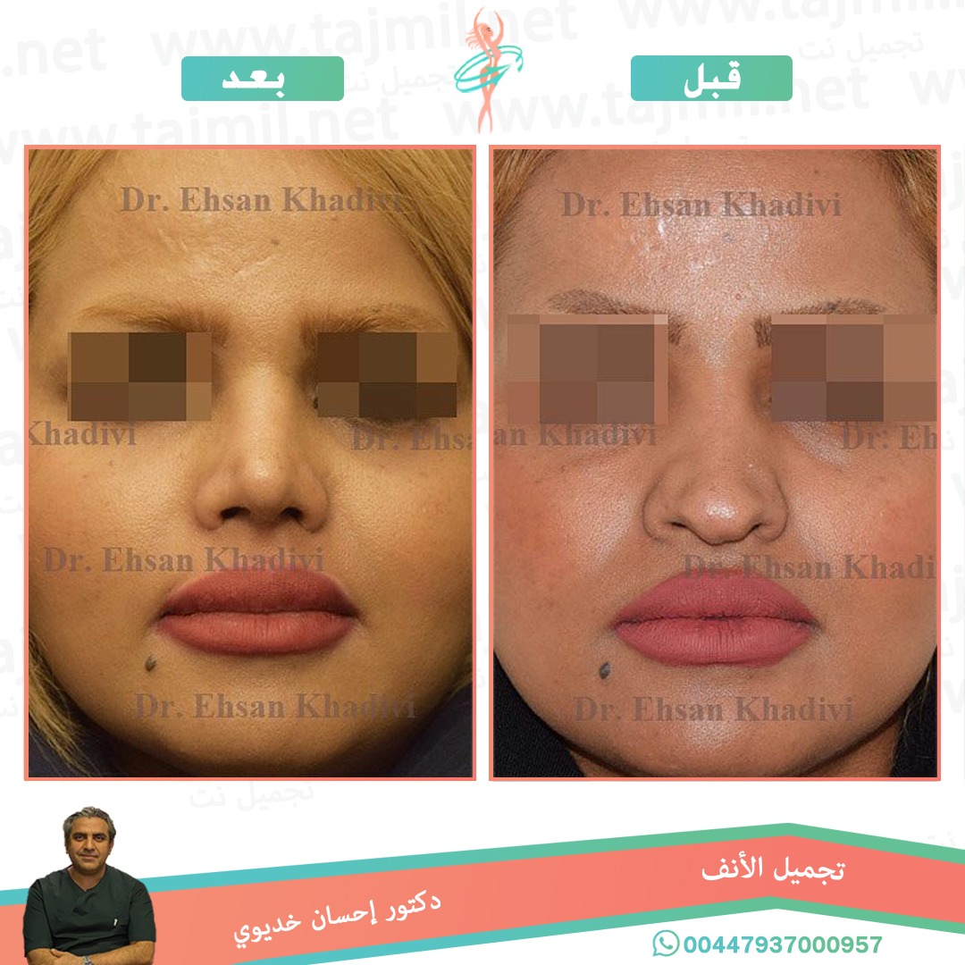  - دکتور إحسان خدیوي عملية تجميل الانف في ايران مع تجميل نت