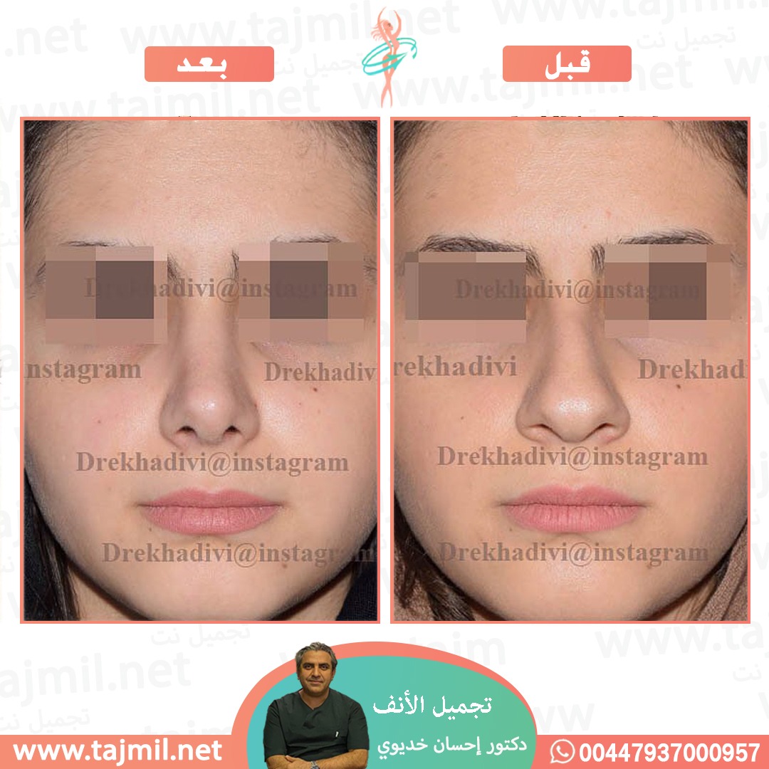  - دکتور إحسان خدیوي عملية تجميل الانف في ايران مع تجميل نت