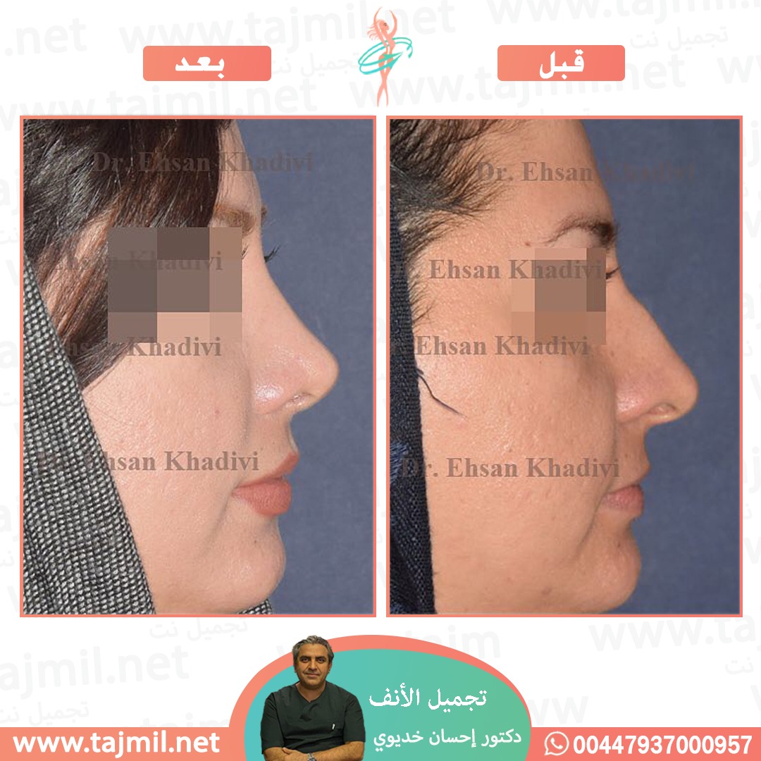  - دکتور إحسان خدیوي عملية تجميل الانف في ايران مع تجميل نت