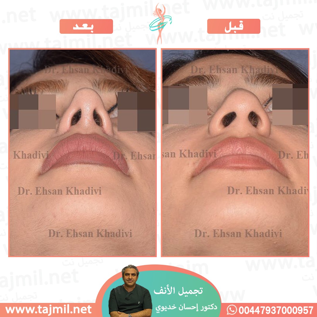  - دکتور إحسان خدیوي عملية تجميل الانف في ايران مع تجميل نت