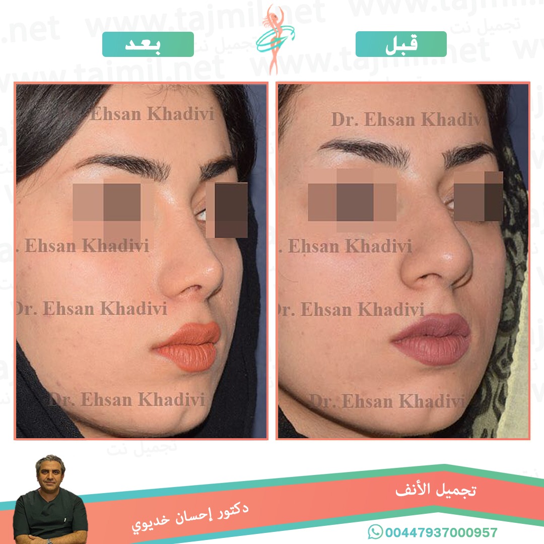  - دکتور إحسان خدیوي عملية تجميل الانف في ايران مع تجميل نت