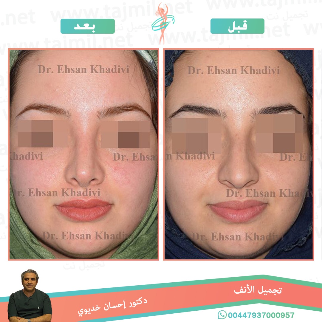  - دکتور إحسان خدیوي عملية تجميل الانف في ايران مع تجميل نت