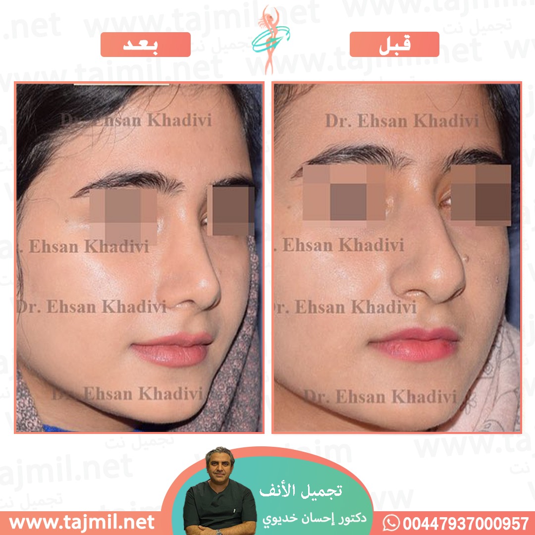  - دکتور إحسان خدیوي عملية تجميل الانف في ايران مع تجميل نت