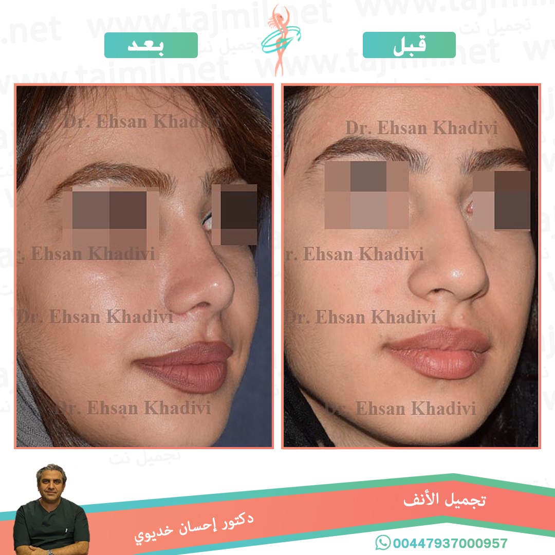  - دکتور إحسان خدیوي عملية تجميل الانف في ايران مع تجميل نت