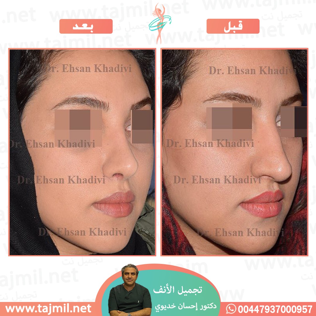  - دکتور إحسان خدیوي عملية تجميل الانف في ايران مع تجميل نت