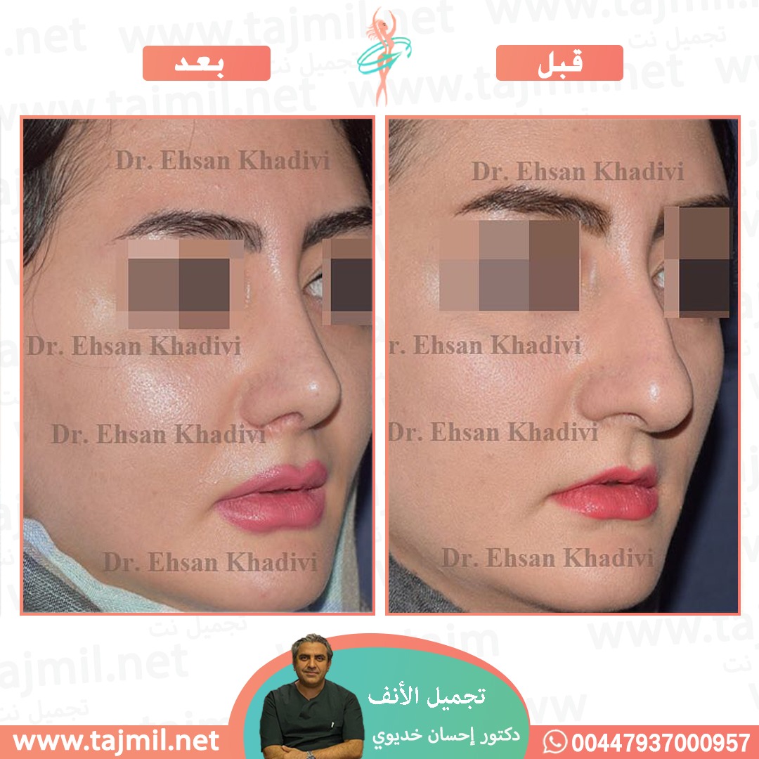  - دکتور إحسان خدیوي عملية تجميل الانف في ايران مع تجميل نت