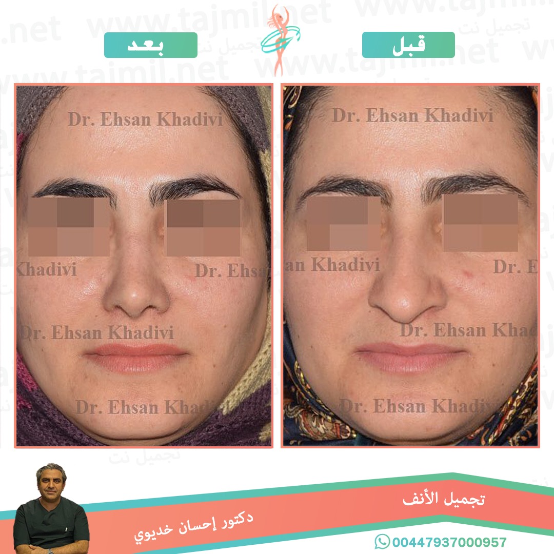  - دکتور إحسان خدیوي عملية تجميل الانف في ايران مع تجميل نت