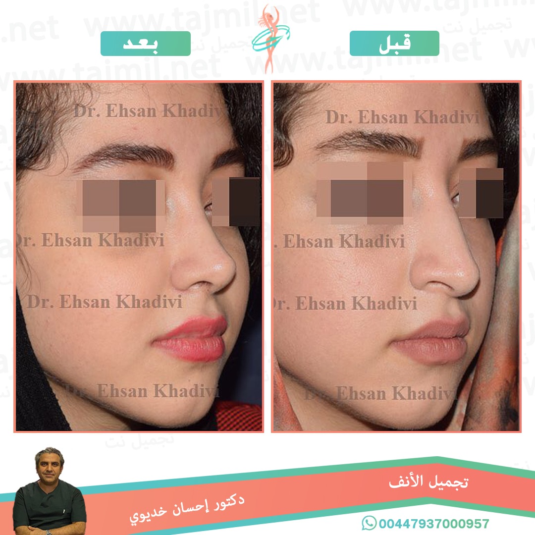  - دکتور إحسان خدیوي عملية تجميل الانف في ايران مع تجميل نت