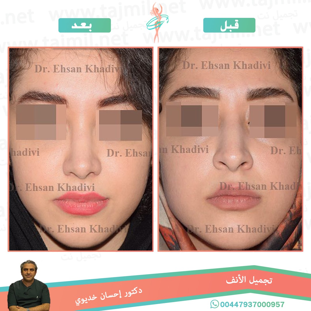  - دکتور إحسان خدیوي عملية تجميل الانف في ايران مع تجميل نت