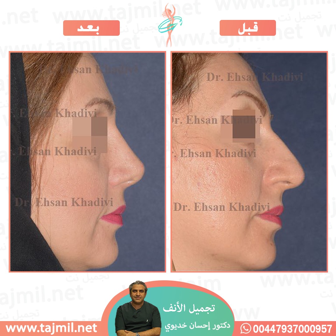  - دکتور إحسان خدیوي عملية تجميل الانف في ايران مع تجميل نت