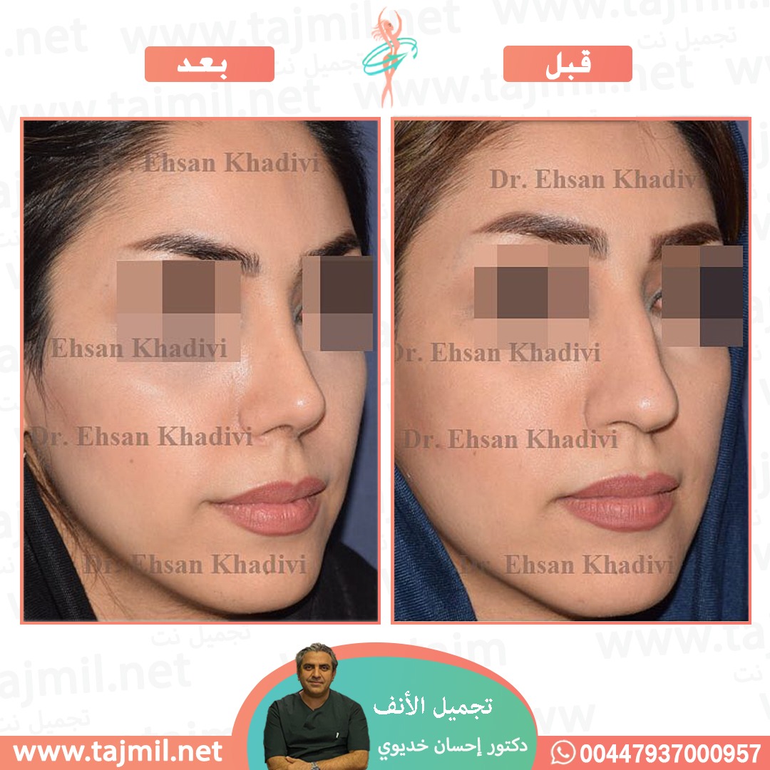  - دکتور إحسان خدیوي عملية تجميل الانف في ايران مع تجميل نت