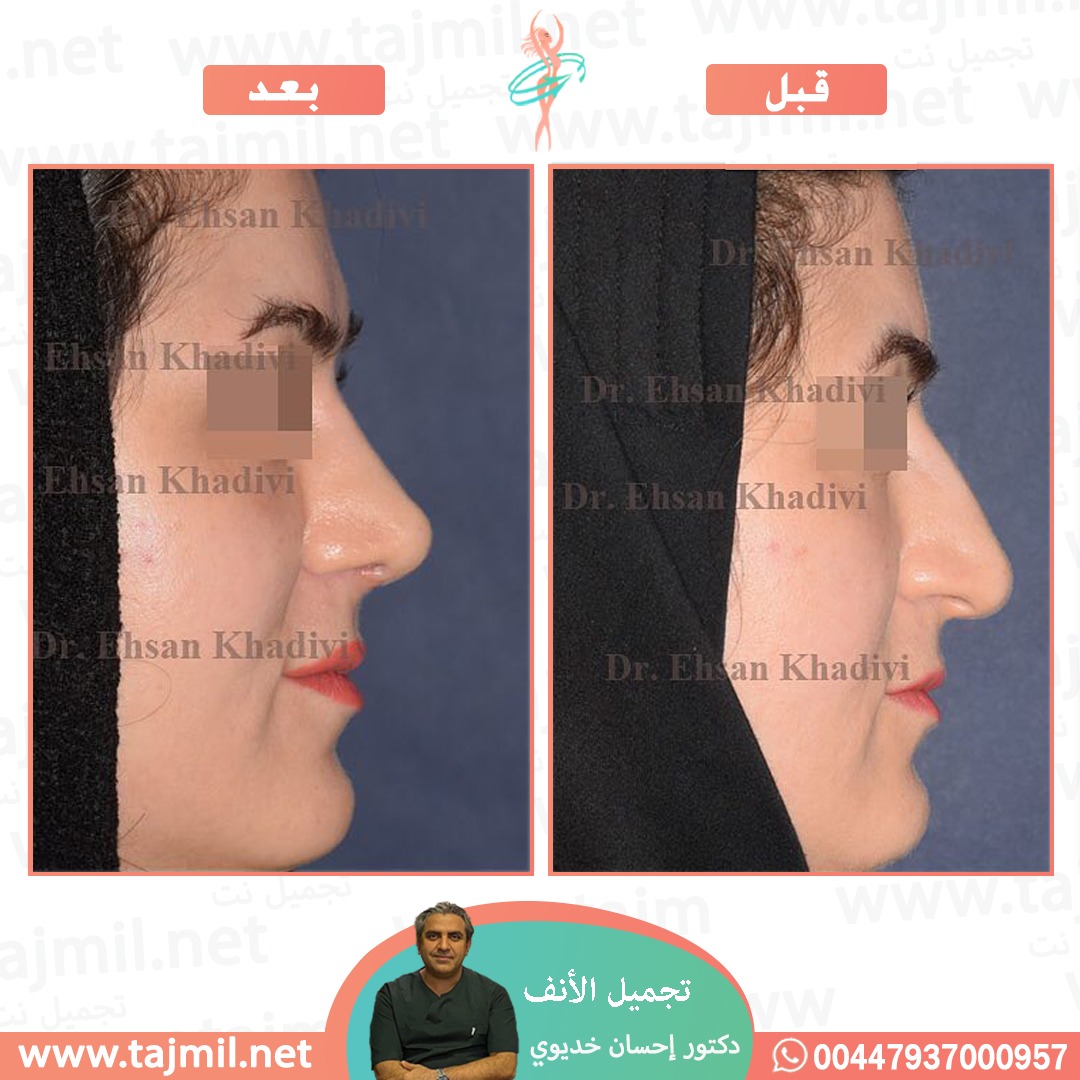  - دکتور إحسان خدیوي عملية تجميل الانف في ايران مع تجميل نت