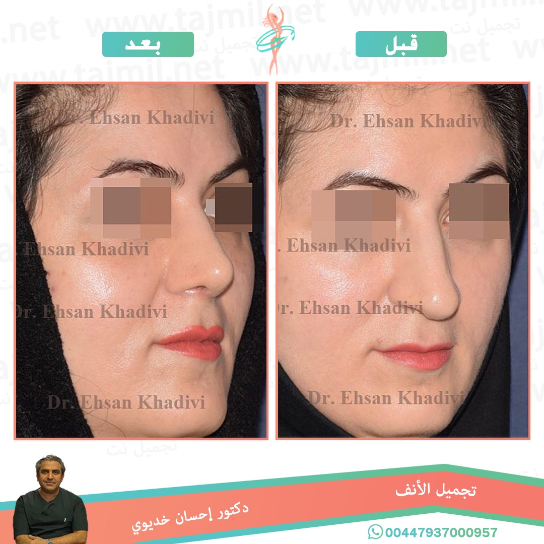  - دکتور إحسان خدیوي عملية تجميل الانف في ايران مع تجميل نت