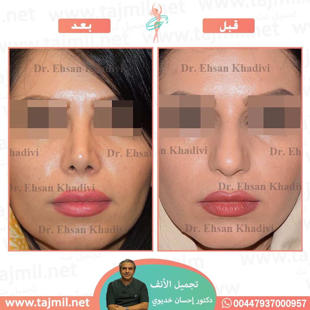  - دکتور إحسان خدیوي عملية تجميل الانف في ايران مع تجميل نت