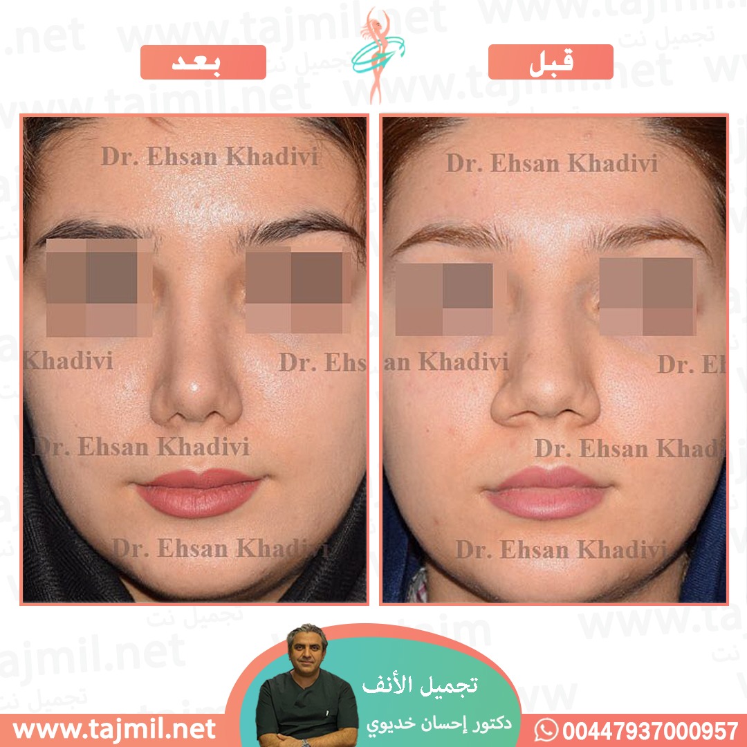  - دکتور إحسان خدیوي عملية تجميل الانف في ايران مع تجميل نت