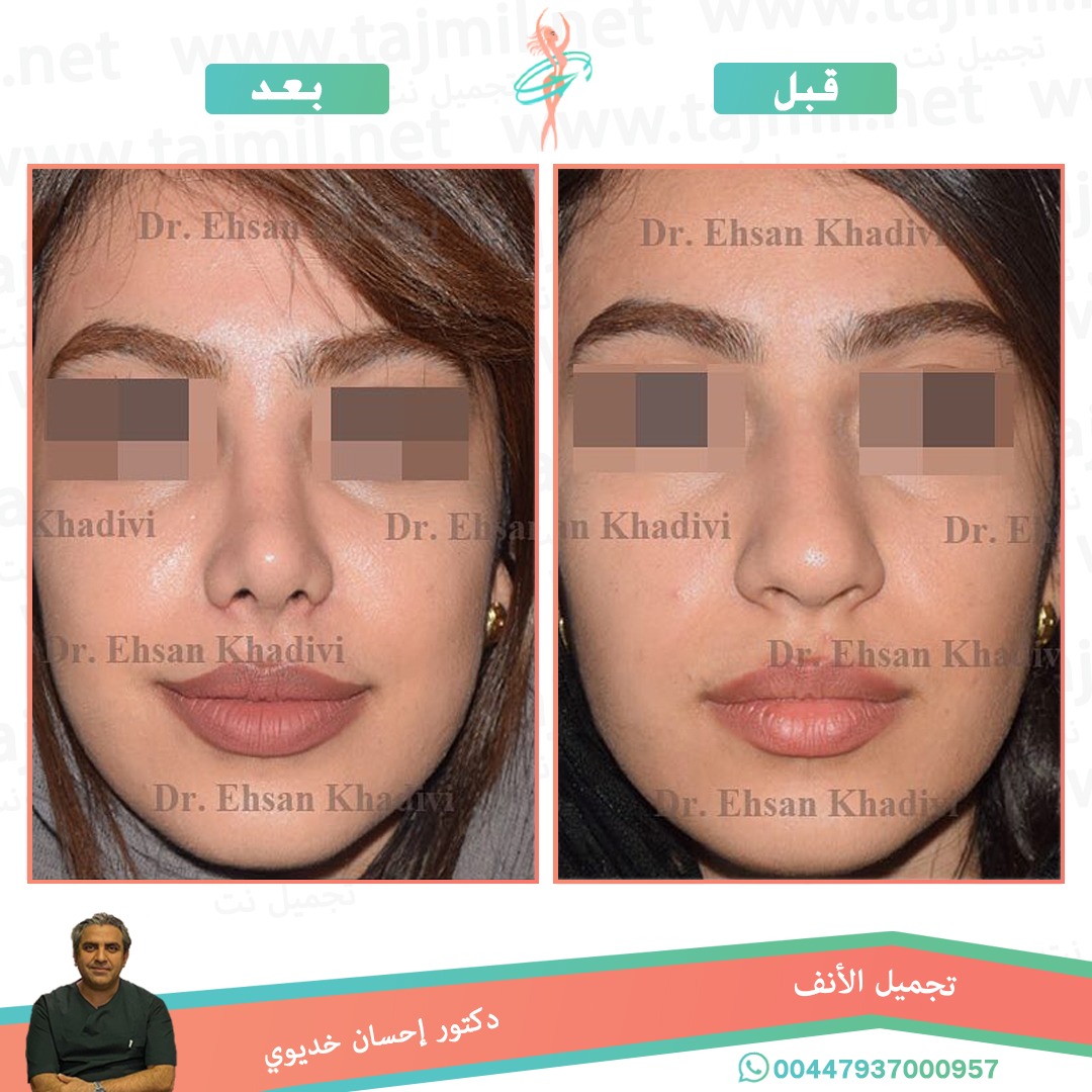  - دکتور إحسان خدیوي عملية تجميل الانف في ايران مع تجميل نت