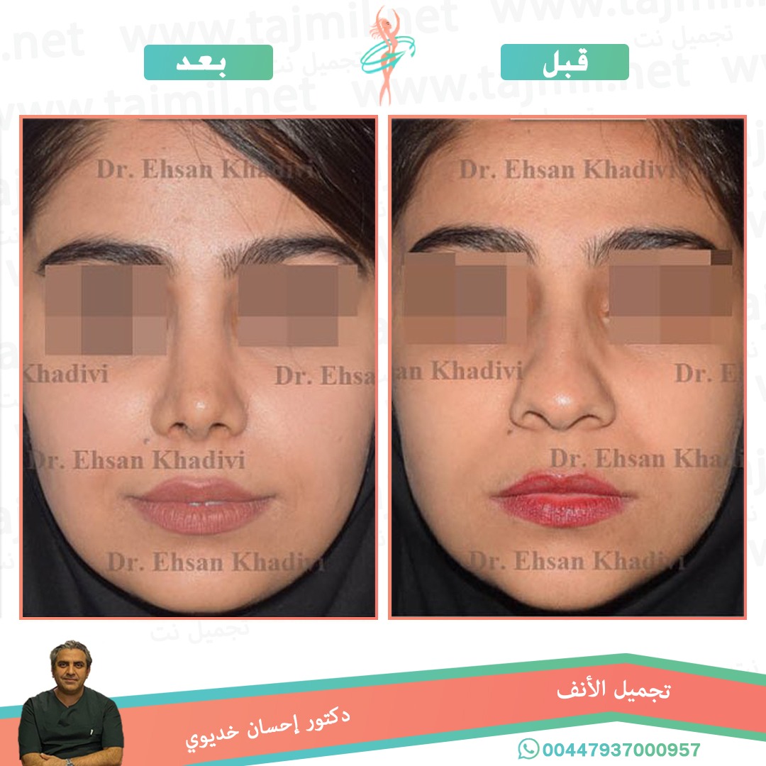  - دکتور إحسان خدیوي عملية تجميل الانف في ايران مع تجميل نت