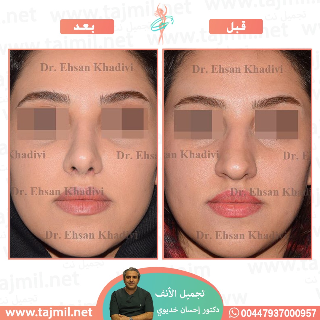  - دکتور إحسان خدیوي عملية تجميل الانف في ايران مع تجميل نت